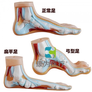 “康為醫(yī)療”正常足、扁平足、弓型足模型