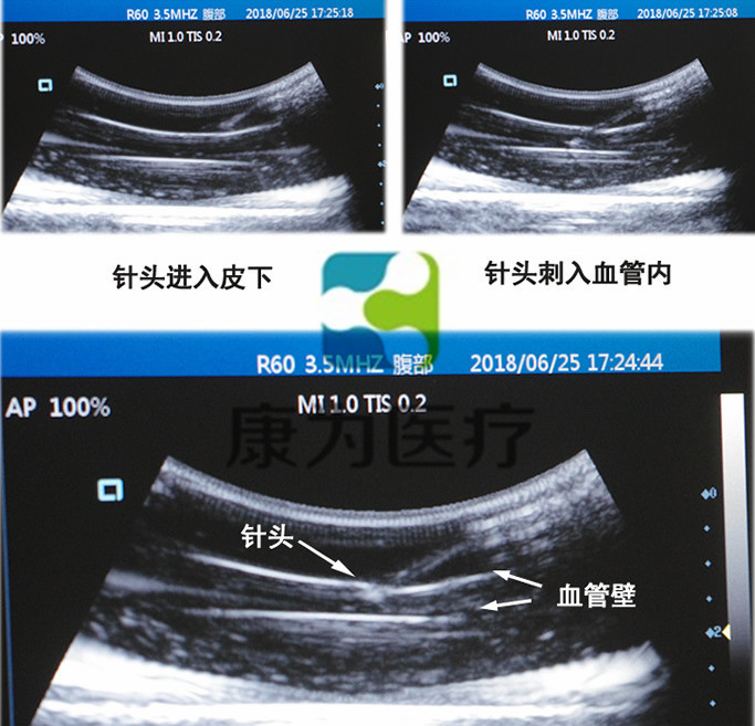 超聲引導(dǎo)下四肢血管活檢模塊